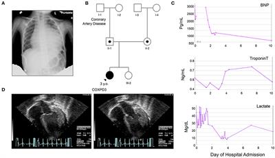 Case Report: Whole Exome Sequencing Identifies Compound Heterozygous Variants in TSFM Gene Causing Juvenile Hypertrophic Cardiomyopathy